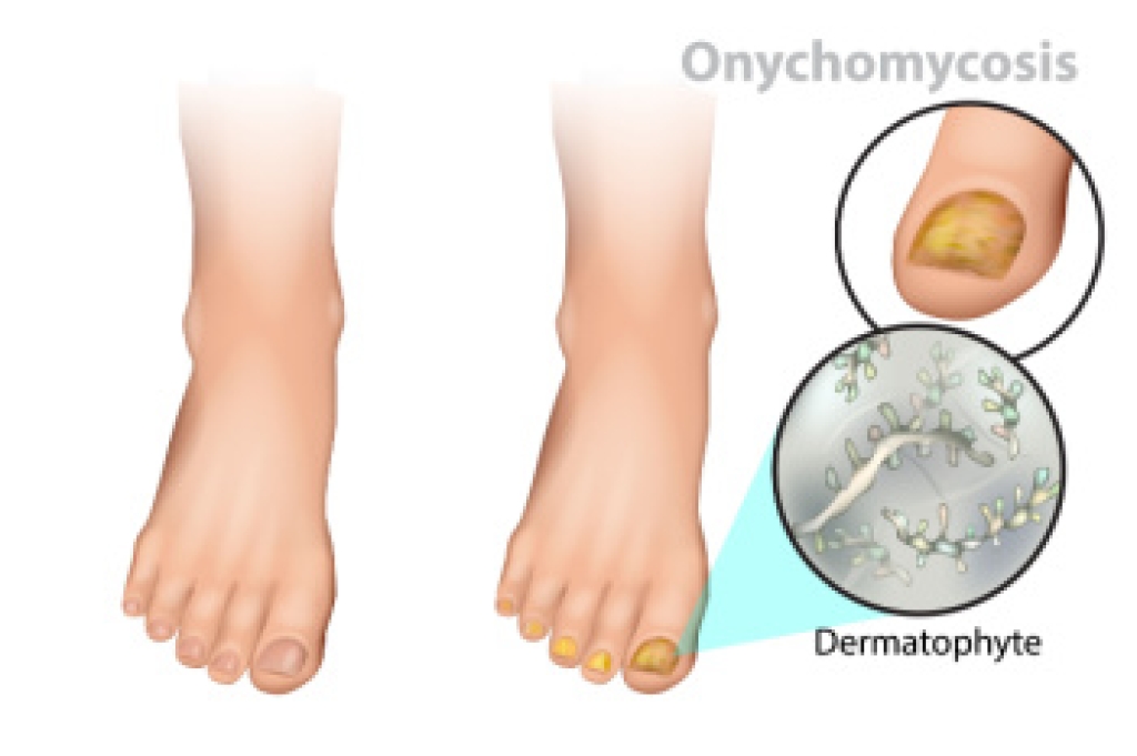 Early Recognition of Toenail Fungus