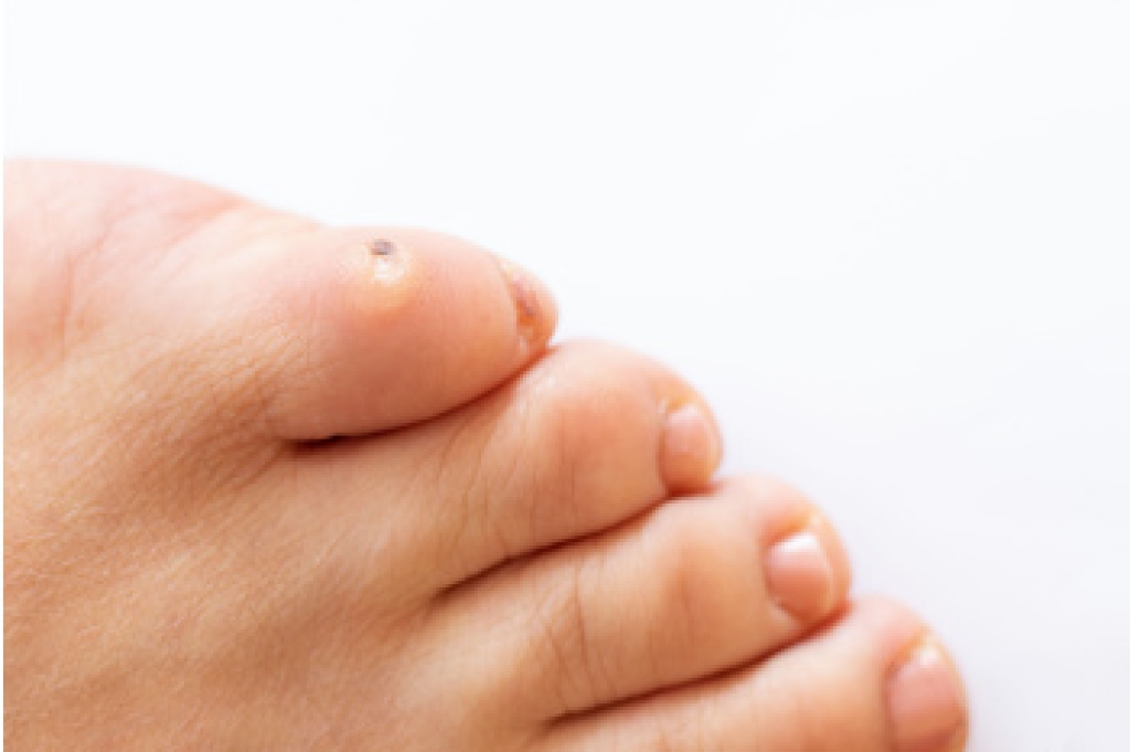 Why Corns Develop on Feet and Toes