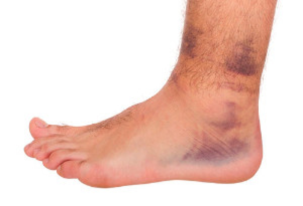 Ankle Sprains Explained From Symptoms to Relief