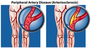 Peripheral Artery Disease and the Feet