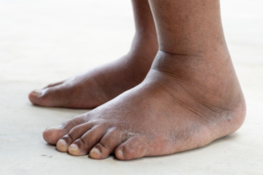 Common Causes Of Swollen Ankles And Effective Relief Methods Common Causes Of Swollen Ankles And Effective Relief Methods