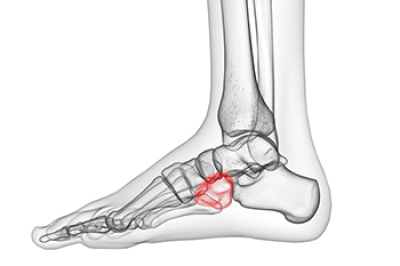 Pain on the Side of the Foot Could Be Cuboid Syndrome