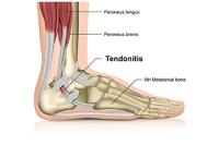 Achilles Tendon Injury in Dancers