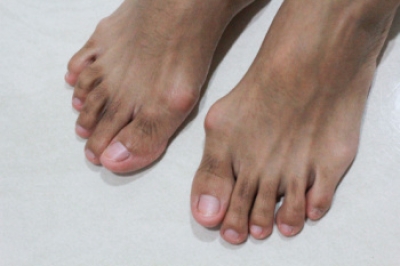 What Is a Bunion?