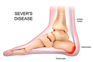 Sever&#039;s Disease in Active Growing Children