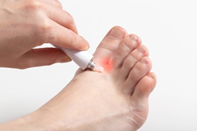Athlete’s Foot and Risk Factors