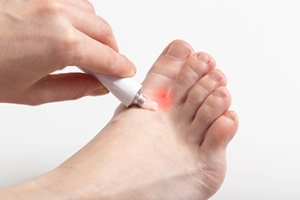 What Are Athlete&#039;s Foot Bumps?