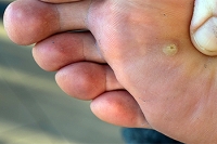 Causes and Prevention of Plantar Warts