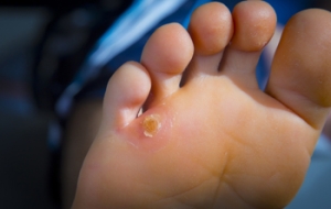 Podiatric Care for Pinky Toe Corns